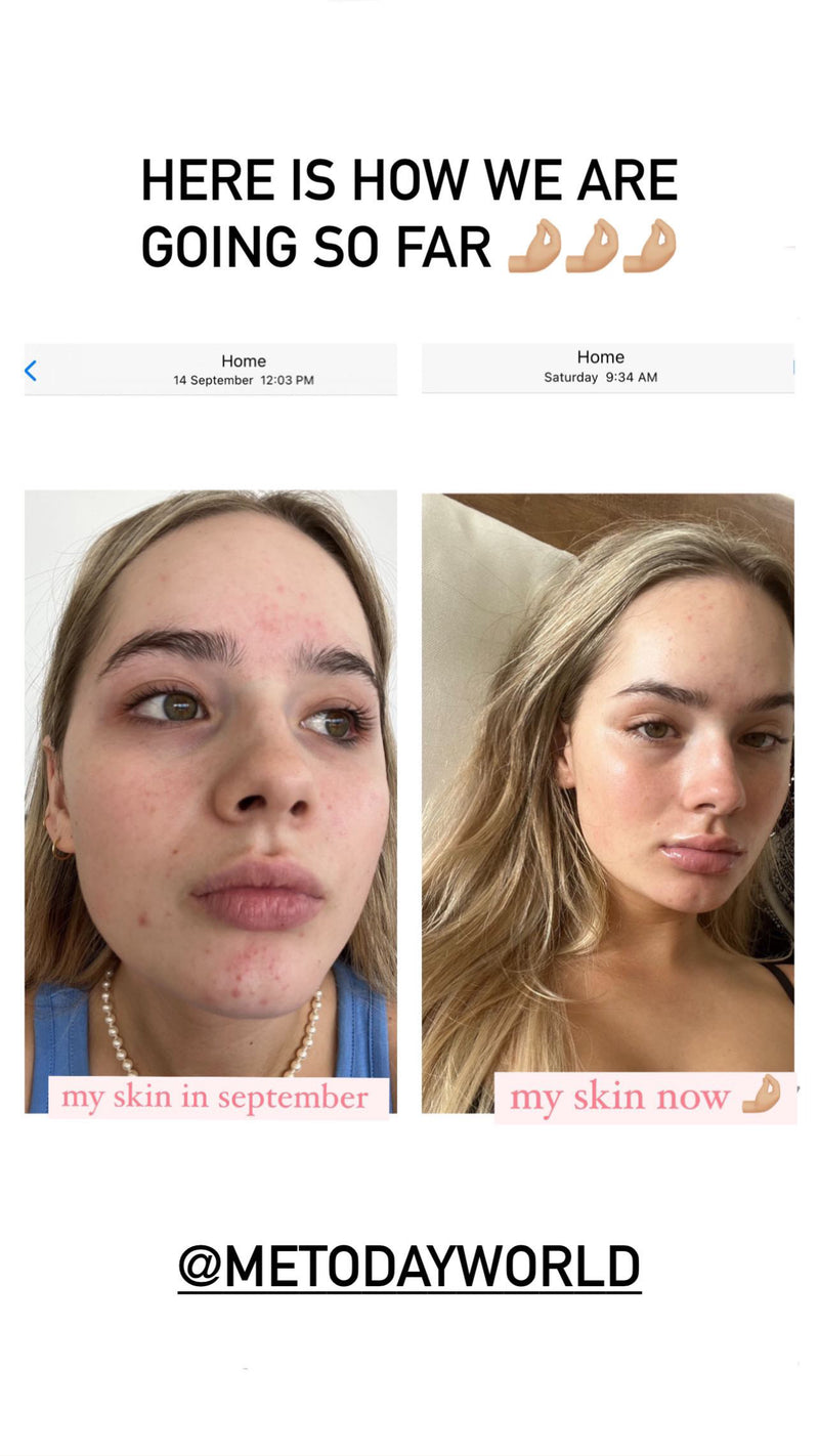 Mānuka Active+ - Blemish Gel